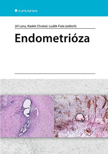 Obrázok Endometrióza