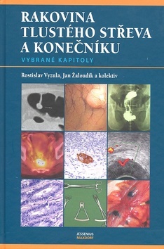 Obrázok Rakovina tlustého střeva a konečníku - vybrané kapitoly