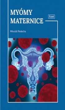 Obrázok Myómy maternice